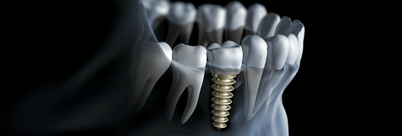 implantologia | Dentista Ghisalba Implantologia | Dentista Ghisalba